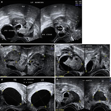 left adnexal mass ultrasound