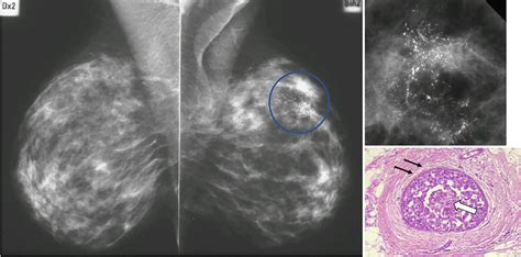 left breast dcis