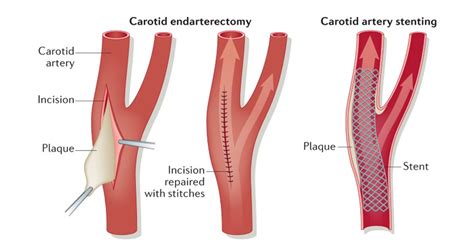 left carotid endarterectomy with dacron patch