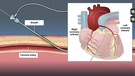 left heart catheterization procedure