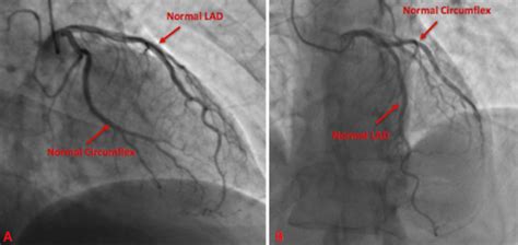 left heart catheterization video