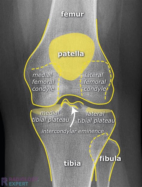 Left Knee Xray Labeled