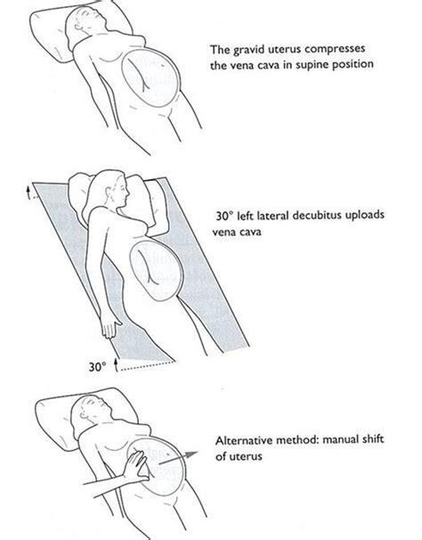 left lateral position in pregnancy