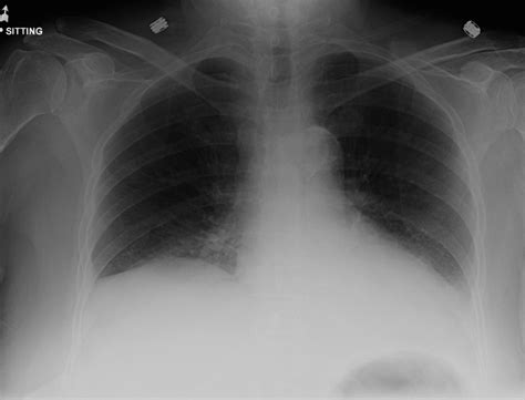 left lower lobe lesion icd 10