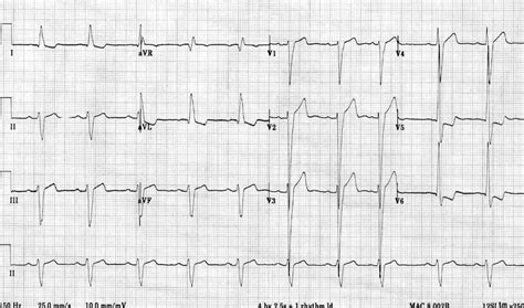 Understanding Left Ventricular Hypertrophy ECG Patterns and Implications