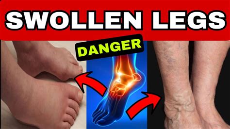 Legs Are Extremely Swollen