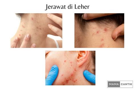 Jerawat di Leher