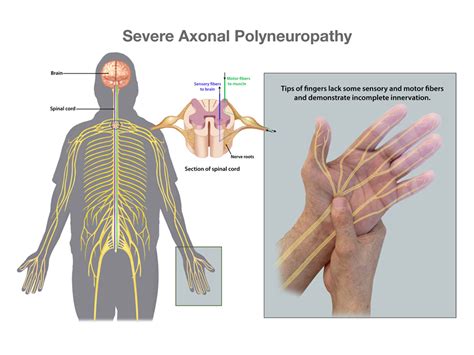 Length Dependent Axonal Sensorimotor Polyneuropathy