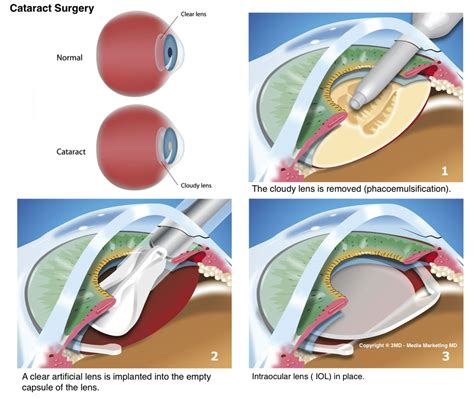 Lens Replacement Surgery Post Op