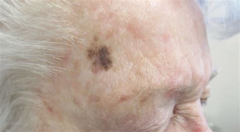 lentigo maligna melanoma nhs