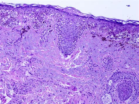 lentigo maligna melanoma pathology