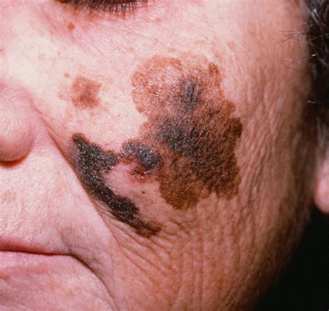 lentigo maligna melanoma pictures