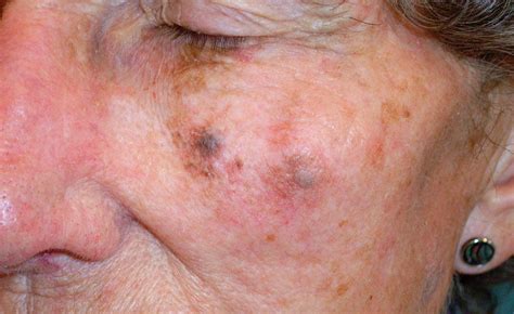 lentigo maligna melanoma symptoms