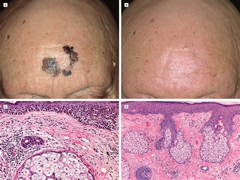 lentigo maligna melanoma treatment