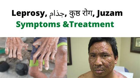 leprosy cured in hindi