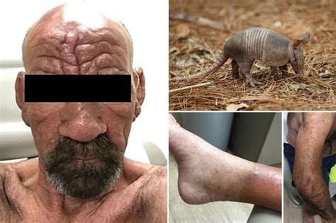 leprosy disease in florida