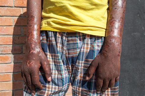 leprosy in florida pictures