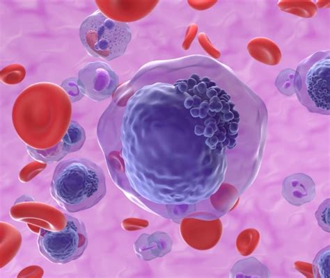 leucemia mielomonocitica cronica prognosi