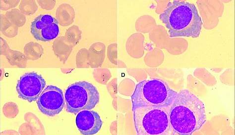 Plasmocytes VS Lymphocytes Medical laboratory science