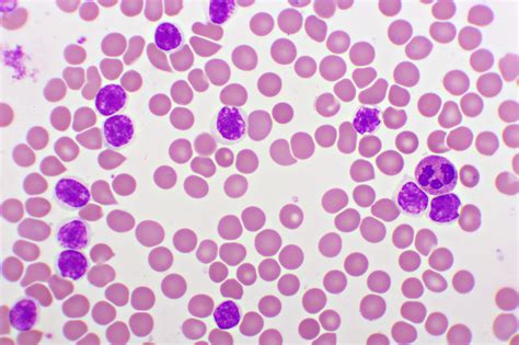 leukaemia cll
