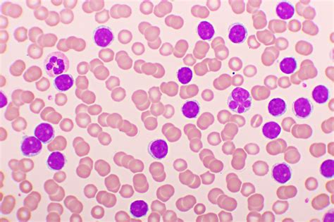 leukemia acute lymphoblastic