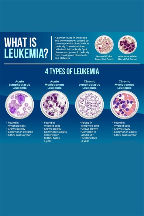 leukemia all type