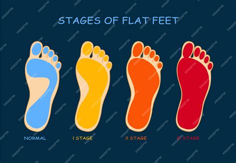 Levels Of Flat Feet