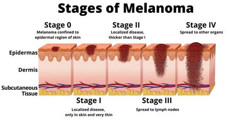 levels of melanoma skin cancer