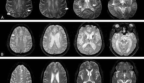 Lewy Body Dementia Brain Scan Radiology Case