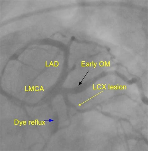 lhc cardiac