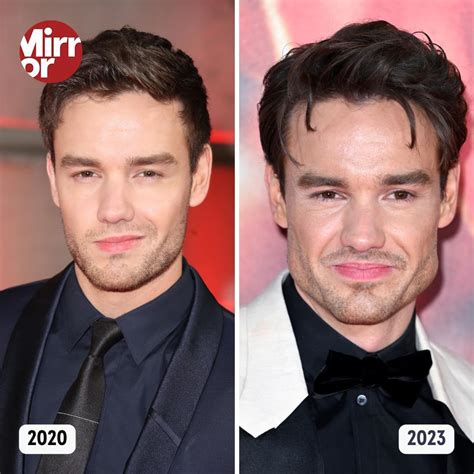 liam payne jaw implants