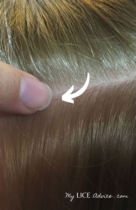 Lice In Blonde Hair: Causes, Symptoms, And Treatment
