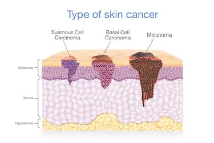life insurance after skin cancer