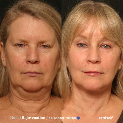 Lift Sagging Cheeks: Tips And Tricks For A Youthful Appearance In 2023