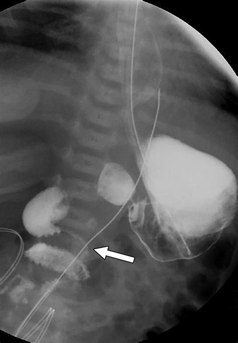 ligament of treitz radiology