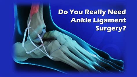 ligaments ankle surgery