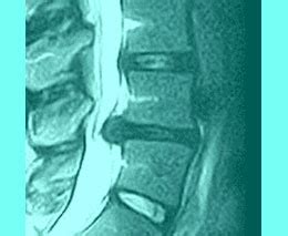 ligamentum flavum hypertrophy symptoms