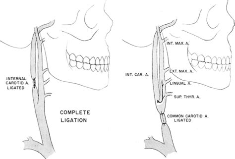 Ligature Around Head