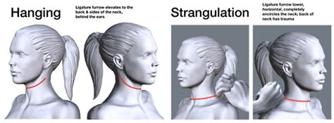 ligature strangulation vs hanging