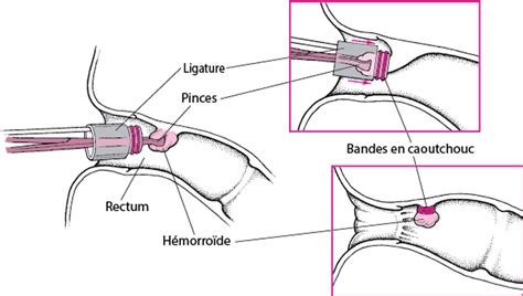 Ligatures Hemorroides Internes