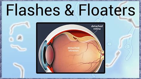 Light Flashes Retinal Detachment