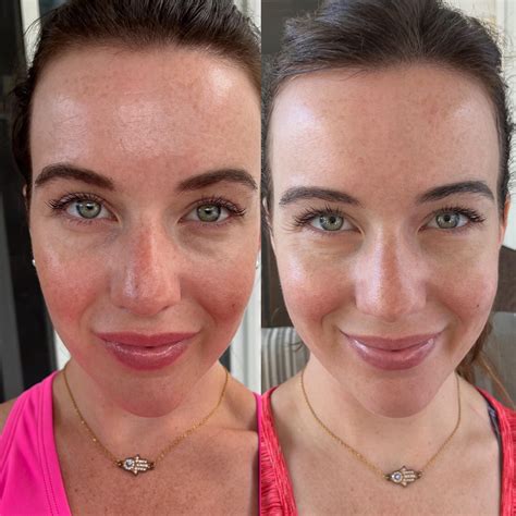 Light Therapy Effectiveness Reddit