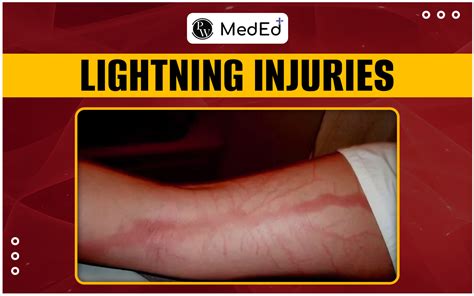 Lightning Injury Lab