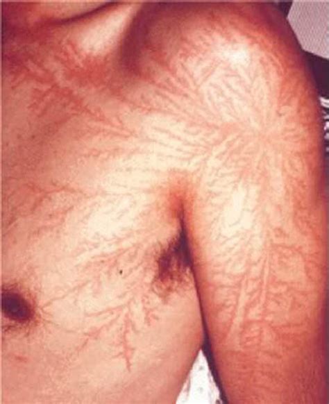 Lightning Strike Scars