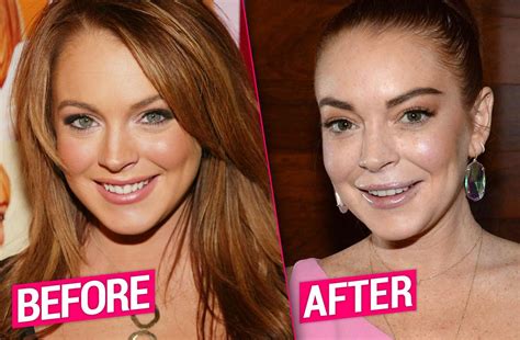 lindsay lohan plastic surgery transformation