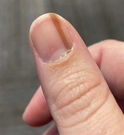 line under fingernail melanoma