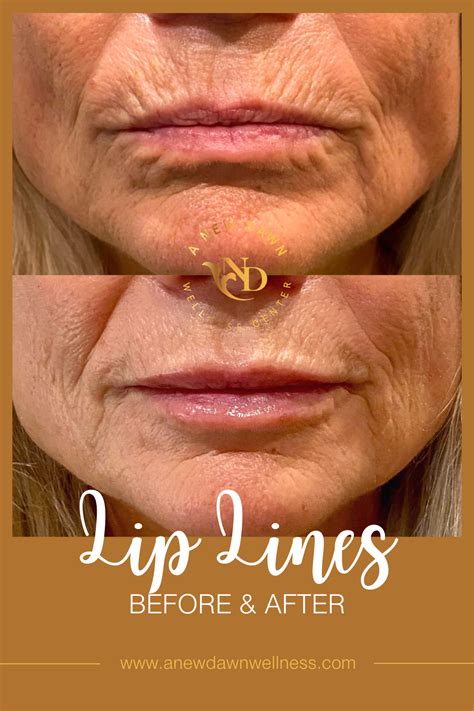 Lines Around Lips After Filler