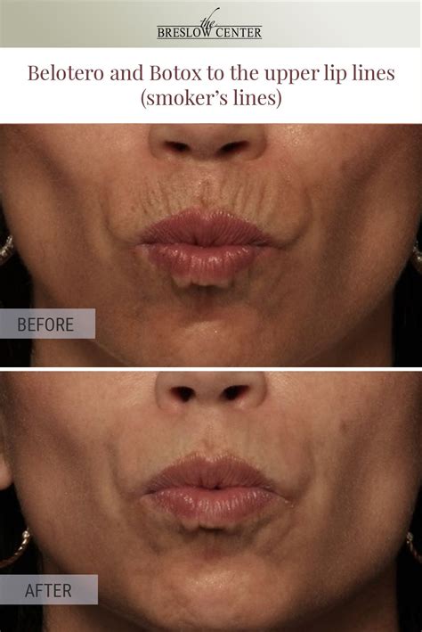Lines On Upper Lip Botox