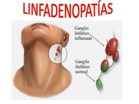 linfoadenopatia o que é
