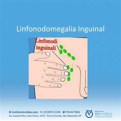 linfonodomegalia em região inguinal